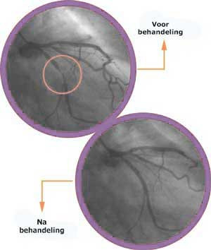 retinopathie